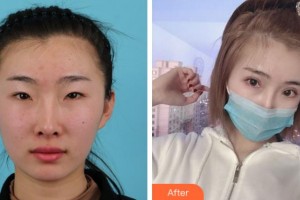 寧波市中醫(yī)院醫(yī)療美容科葉靜靜整形價格表附眼部綜合案例展示