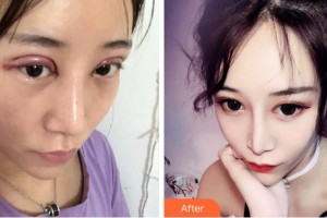 寧波市北侖區(qū)人民醫(yī)院眼科陳艷紅整形價格表附切開雙眼皮案例展示