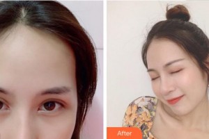 寧波市北侖區(qū)人民醫(yī)院眼科楊崇清整形價格表附眼部綜合案例展示