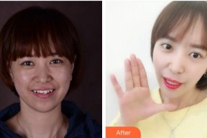 寧波鄞州德中口腔門診部何澤紅整形價(jià)格表附隱形托槽矯正案例展示