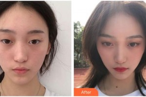 寧波明州醫(yī)院眼科李燕波整形價(jià)格表附眼部綜合案例展示