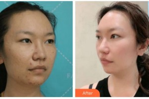 寧波市華慈醫(yī)院眼科周偉整形價(jià)格表附切開雙眼皮案例展示