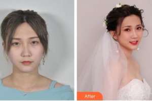 寧波明州醫(yī)院眼科余亞波整形價(jià)格表附眼部綜合案例展示