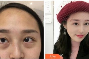 寧波市華慈醫(yī)院眼科劉艷婷整形價(jià)格表附內(nèi)切祛眼袋案例展示