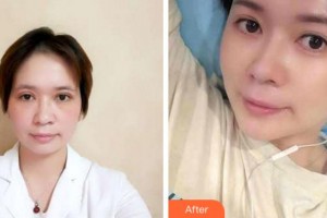 寧波藝星整形美容醫(yī)院潘炯波整形價(jià)格表附切開雙眼皮案例展示