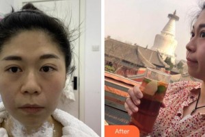 寧波藝星整形美容醫(yī)院李欣言整形價(jià)格表附熱瑪吉案例展示