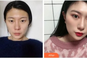 溫州和平整形醫(yī)院王煒整形價(jià)格表附切開雙眼皮案例展示