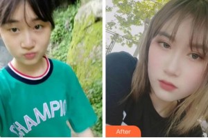 溫州和平整形醫(yī)院薛志輝整形價(jià)格表附眼部綜合案例展示