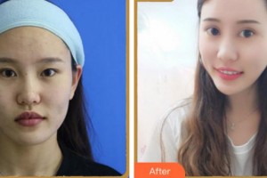 溫州和平整形醫(yī)院梁贊姜整形價(jià)格表附眼部綜合案例展示