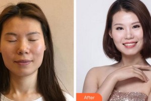 溫州藝星醫(yī)學(xué)美容醫(yī)院李春新整形價(jià)格表附眼部整形案例展示