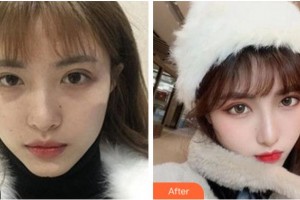 溫州藝星醫(yī)學(xué)美容醫(yī)院周聰鐸整形價(jià)格表附熱瑪吉案例展示