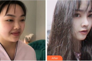 溫州藝星醫(yī)學(xué)美容醫(yī)院新倉(cāng)辛一整形價(jià)格表附術(shù)前眼皮松弛案例展示