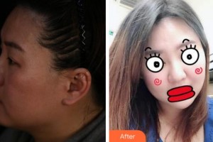 溫州雅美姬整形美容醫(yī)院白晉整形價(jià)格表附埋線提升案例展示