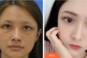 溫州藝星醫(yī)學(xué)美容醫(yī)院譚立文整形價(jià)格表附埋線提升案例展示