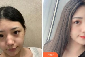 溫州解放軍118醫(yī)院整形科李恒進(jìn)整形價(jià)格表附激光祛斑案例展示