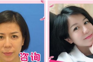 溫州藝星醫(yī)學(xué)美容醫(yī)院湯忠緯整形價(jià)格表附埋線提升案例展示