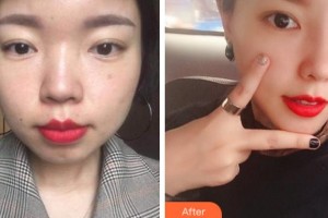 溫州醫(yī)學(xué)院附屬第一醫(yī)院整形外科李力群整形價(jià)格表附耳軟骨復(fù)合隆鼻案例展示