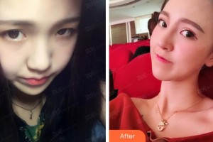 溫州藝星醫(yī)學(xué)美容醫(yī)院楊連華整形價(jià)格表附鼻部綜合案例展示