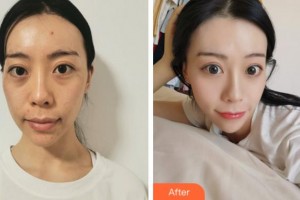溫州友好醫(yī)院整形美容中心陳瑤整形價(jià)格表附埋線提升案例展示