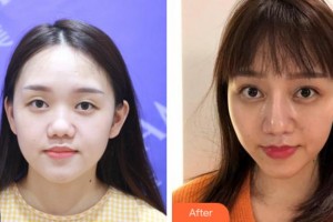 溫州藝美整形美容醫(yī)院顧斌整形價格表附眼部綜合案例展示