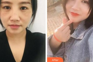 溫州韓美整形美容醫(yī)院紀(jì)強(qiáng)整形價格表附眼部綜合案例展示