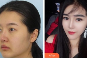 溫州藝美整形美容醫(yī)院徐莎整形價格表附眼部綜合案例展示