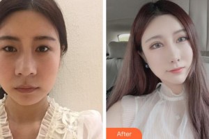 溫州韓星醫(yī)療美容門診部陳美香整形價格表附眼部綜合案例展示