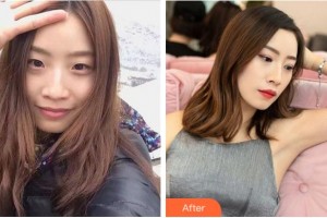 溫州芘麗芙美容醫(yī)院劉永楊整形價格表附埋線雙眼皮案例展示