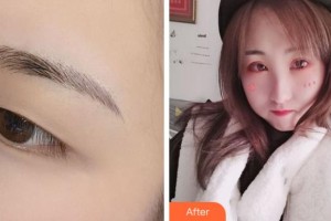 溫州藝星醫(yī)學(xué)美容醫(yī)院馬秀芬整形價格表附切開雙眼皮案例展示