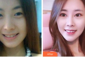 溫州東華醫(yī)院醫(yī)療美容科孫艷華整形價格表附定點(diǎn)雙眼皮案例展示