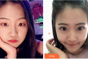 溫州星范醫(yī)學(xué)美容門診部應(yīng)天詳整形價格表附切開雙眼皮案例展示