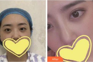 溫州藝星醫(yī)學(xué)美容醫(yī)院柴軍整形價格表附眼部綜合案例展示