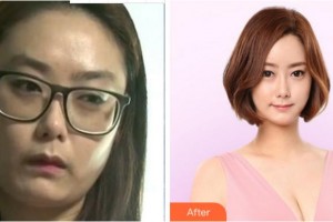 溫州藝星醫(yī)學(xué)美容醫(yī)院成浩整形價格表附內(nèi)切祛眼袋案例展示