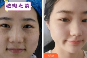 溫州上雅醫(yī)學(xué)美容門診部吳慧明整形價格表附激光祛斑案例展示