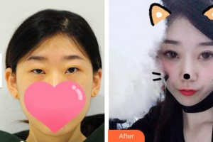 溫州藝星醫(yī)學(xué)美容醫(yī)院黃樂整形價格表附切開雙眼皮案例展示