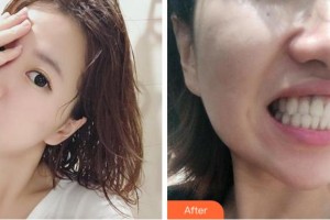 溫州牙科醫(yī)院陳海兵整形價格表附牙齒陶瓷矯正案例展示