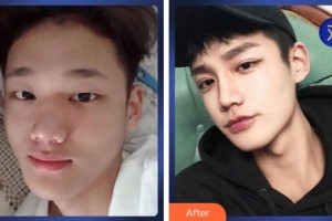 溫州伯思立醫(yī)院醫(yī)療美容科周亞超整形價(jià)格表附切開雙眼皮案例展示