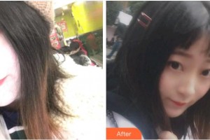 溫州醫(yī)科大學(xué)附屬口腔學(xué)院金向青整形價(jià)格表附金屬托槽矯正案例展示