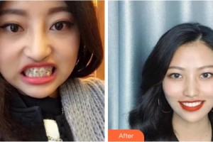 溫州醫(yī)科大學(xué)附屬口腔學(xué)院劉傳通整形價(jià)格表附牙齒陶瓷矯正案例展示