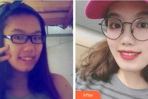 溫州醫(yī)科大學(xué)附屬口腔學(xué)院鄭敏玲整形價(jià)格表附隱形托槽矯正案例展示