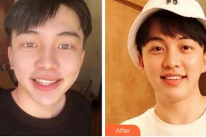 溫州醫(yī)科大學(xué)附屬口腔學(xué)院王劍鋒整形價(jià)格表附美白貼片案例展示