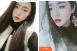 溫州醫(yī)科大學(xué)附屬口腔學(xué)院聶鑫整形價(jià)格表附金屬托槽矯正案例展示