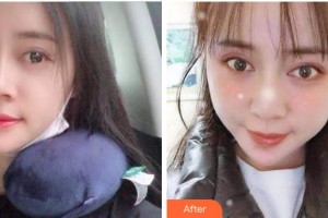 溫州醫(yī)科大學(xué)附屬口腔學(xué)院王思錢整形價(jià)格表附自鎖托槽矯正案例展示