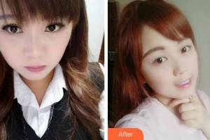 溫州王曉峰口腔醫(yī)院張麗莉整形價(jià)格表附牙齒隱形矯正案例展示