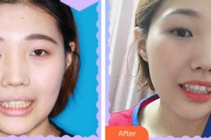 溫州王曉峰口腔醫(yī)院夏永微整形價(jià)格表附牙齒隱形矯正案例展示