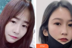 溫州明樂眼科醫(yī)院蔡迎暉整形價(jià)格表附切開雙眼皮案例展示