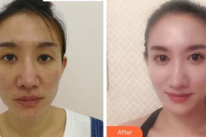 溫州明樂眼科醫(yī)院程鷺整形價(jià)格表附切開雙眼皮案例展示