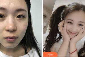 溫州明樂眼科醫(yī)院樸正勛整形價(jià)格表附眼部綜合案例展示