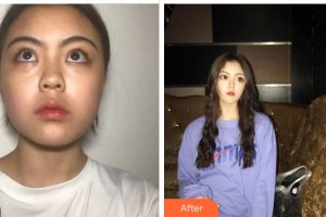 溫州明樂眼科醫(yī)院陳曉明整形價(jià)格表附內(nèi)切祛眼袋案例展示