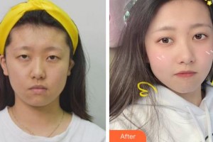 溫州明樂眼科醫(yī)院季娟娟整形價(jià)格表附眼部綜合案例展示